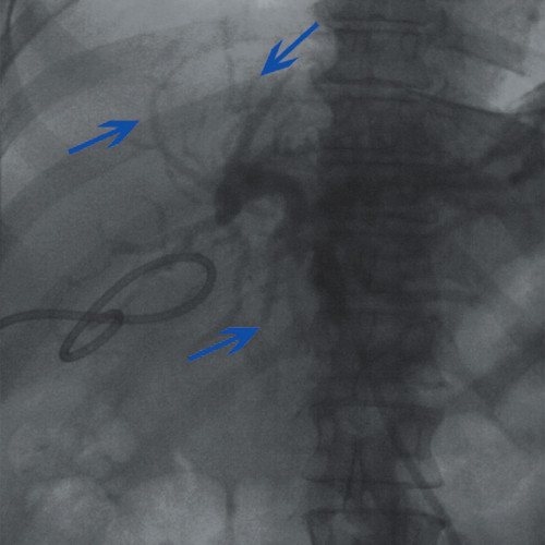 Cholangiography - tumor of the porta hepatis, contrasting the ducts of the left lobe of the liver (blue arrows)