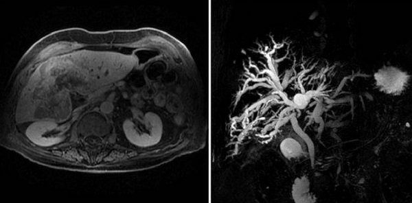 Cholangiocarcinoma on MRI images