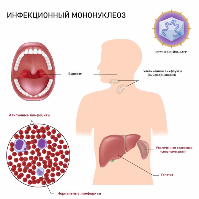 Infectious mononucleosis.jpg