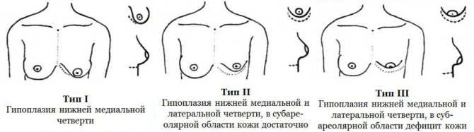 infographics about types of mammary hyperplasia
