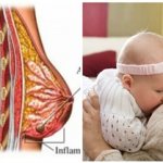 Как отличить мастит от лактостаза: симптомы мастита у кормящей мамы