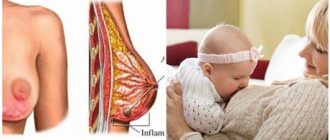 Как отличить мастит от лактостаза: симптомы мастита у кормящей мамы