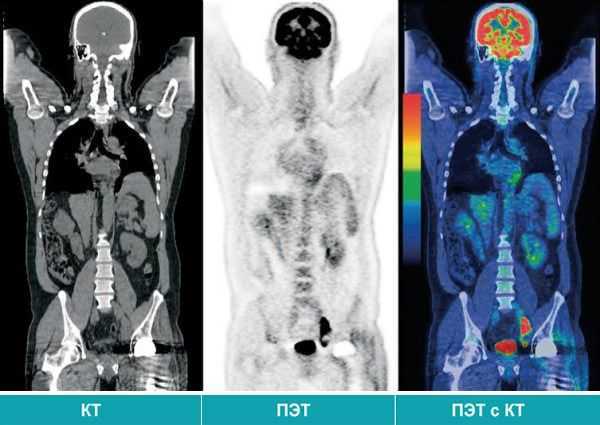 How to get a referral for a PET CT scan under the compulsory medical insurance policy for the diagnosis of cancer?