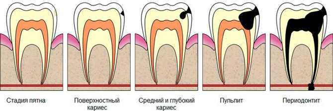 Caries and pulpitis