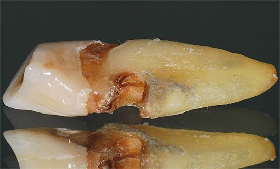 Кариес корня, зачастую развиваясь незаметно под десной, в итоге может привести к выпадению зуба или необходимости его удаления.
