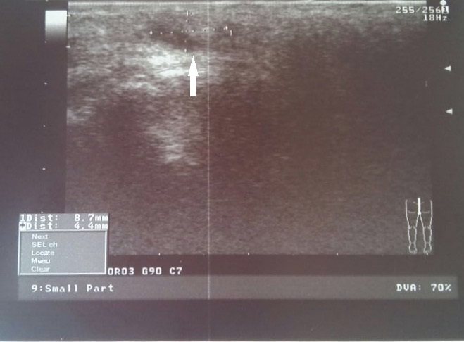 Coccyx cyst. Ultrasound 