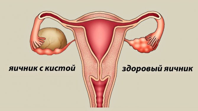 Ovarian cysts: classification, clinical picture, diagnosis and treatment