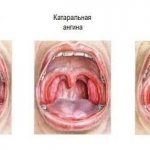 Classification of sore throats