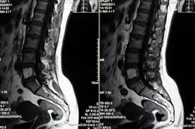 Coccydynia on MRI