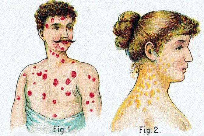 contagiousness of syphilis