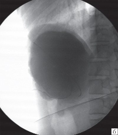 Contrast angiogram of a giant primary splenic cyst