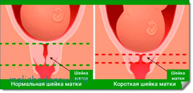Short cervix during pregnancy