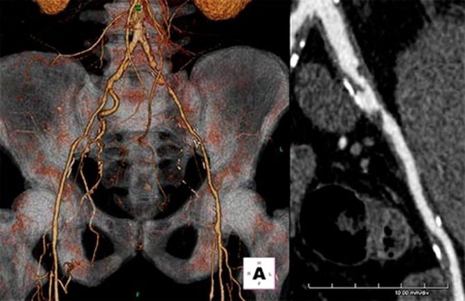 CT angiography of the pelvis