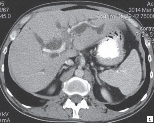 CT scan of the abdomen - arterial phase