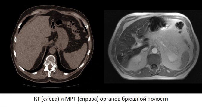 CT and MRI of the abdominal cavity