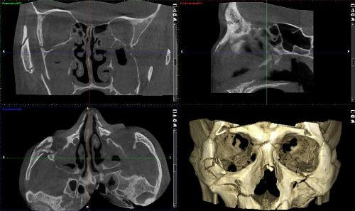 CT scan of facial bones