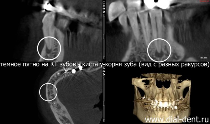 CT scan of teeth - visible cyst at the root of the tooth