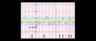 CTG (cardiotocography)