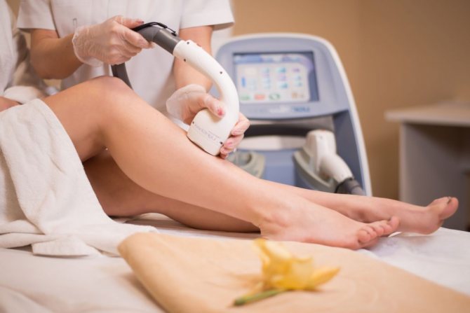 Laser hair removal of legs