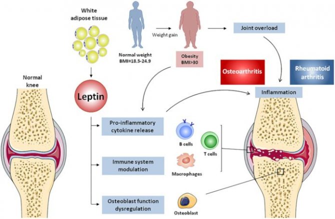 Leptin increases inflammation in rheumatoid arthritis and osteoarthritis