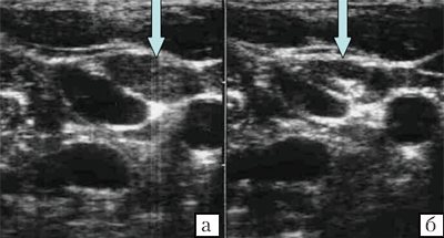 Лимфатические узлы шеи (через 1 год после операции по поводу рака щитовидной железы)