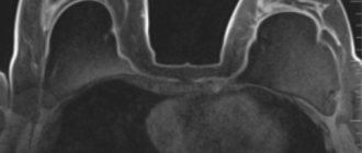 Магнитно-резонансная томография груди с имплантами