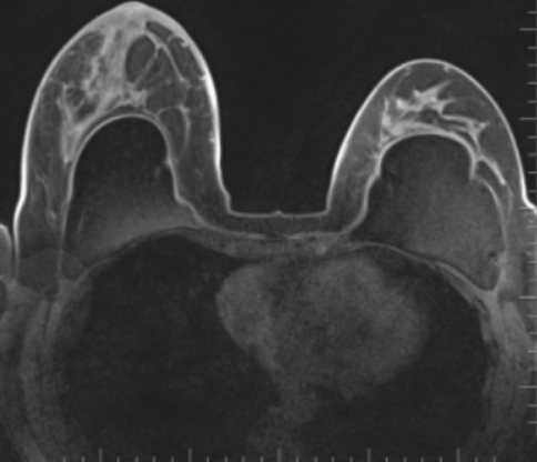 Magnetic resonance imaging of breasts with implants