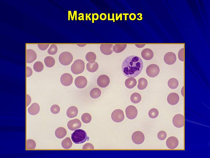 Macrocytosis