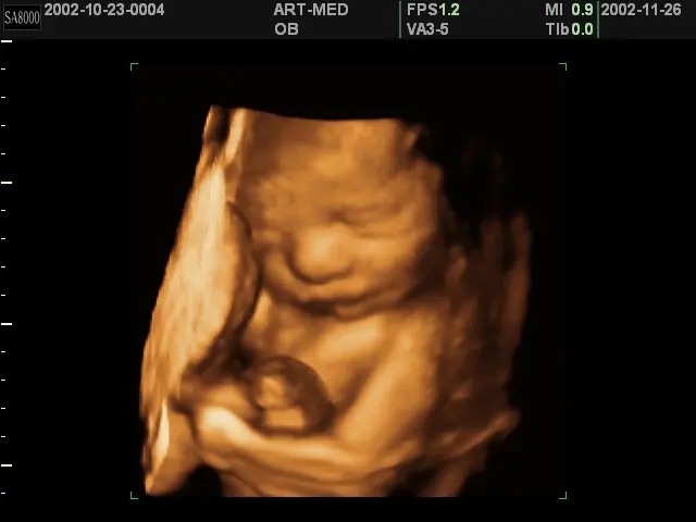 Baby at 36 weeks of pregnancy