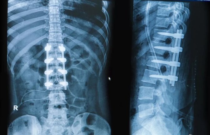 metal structures on x-ray