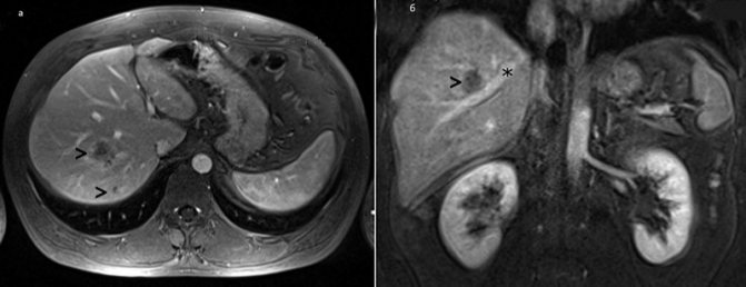 Metastatic liver lesion on MRI image