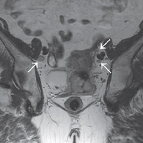 Metastatic enlargement of regional lymph nodes on MRI