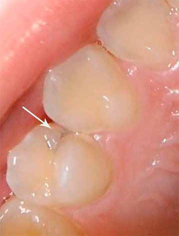 Interdental (approximal) caries often occurs in a hidden form, without visually revealing itself.