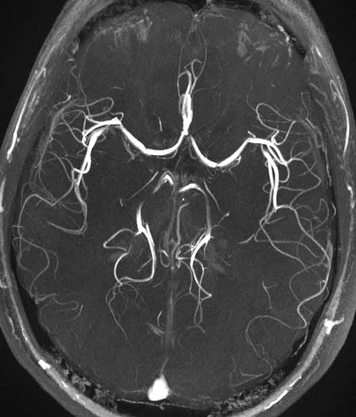 MRI of brain arteries