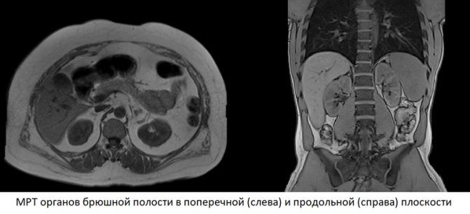 Abdominal MRI