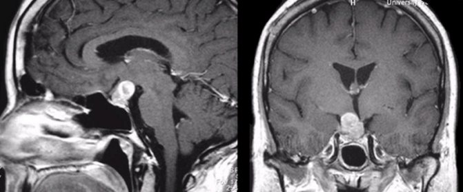 MRI of the pituitary gland with contrast