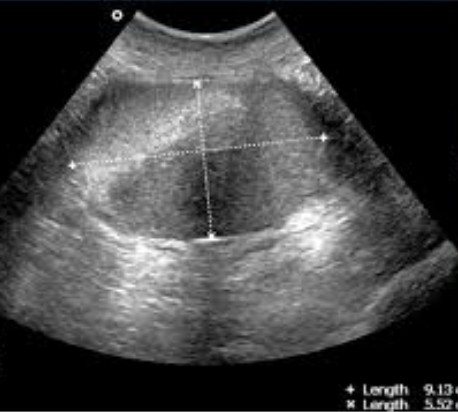 MRI or ultrasound of the pelvis