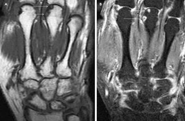 MRI of the hand and wrist with contrast