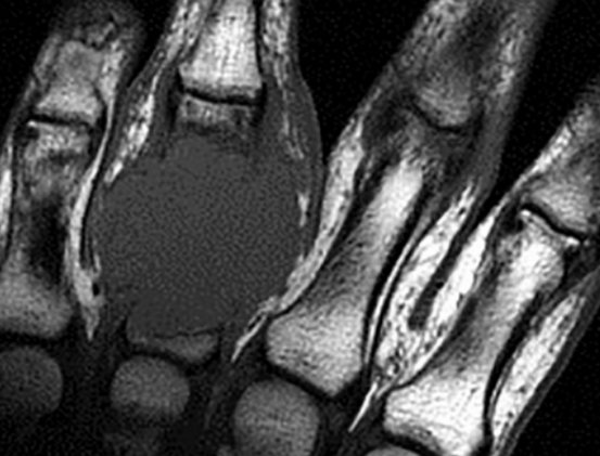 MRI of the hand, which shows