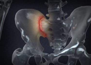 MRI of the sacroiliac joints