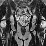 MRI of the pelvis in a woman