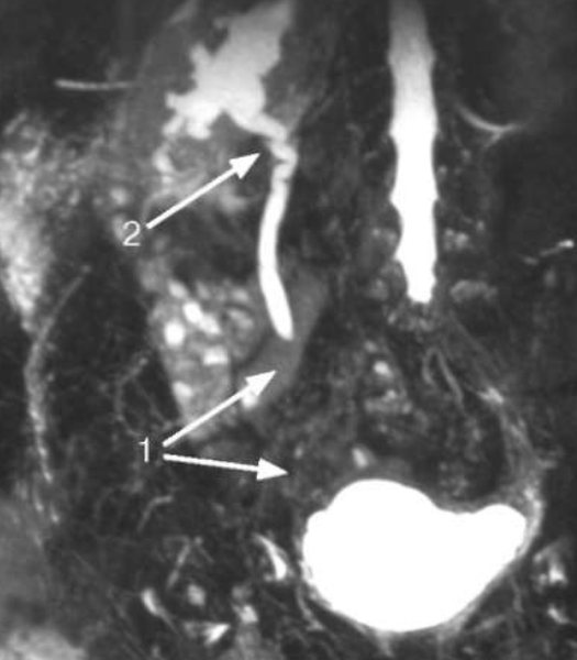MRI of the kidneys - obliteration and hydroureteronephrosis
