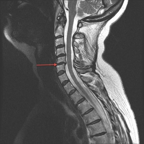 MRI of the lumbar spine