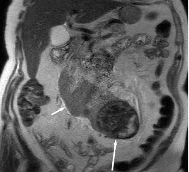 MRI of fused kidneys