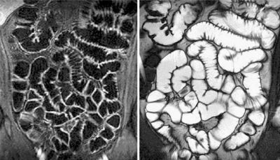MRI of the large intestine