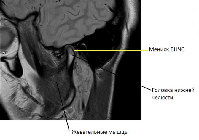 МРТ височно-нижнечелюстного сустава