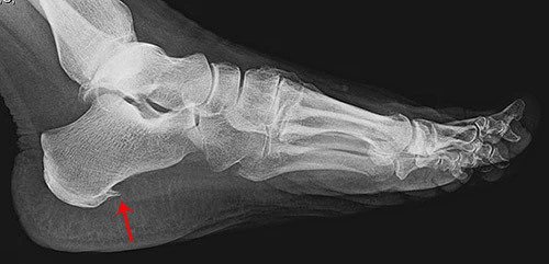 In the photo you see an x-ray of a heel spur