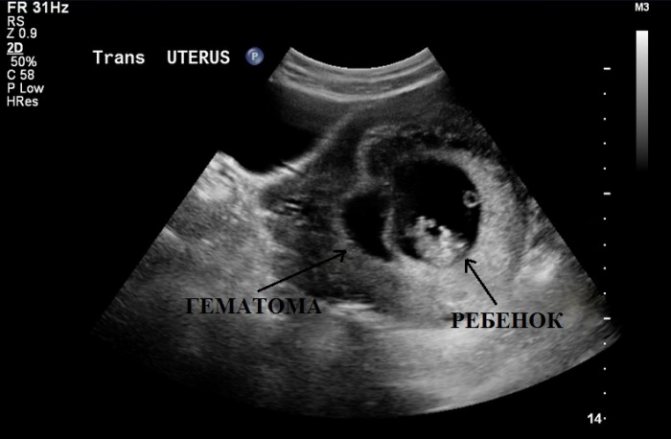 The presence of a hematoma between the uterus and the fertilized egg during ultrasound examination