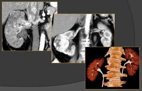 kidney CT scan with contrast