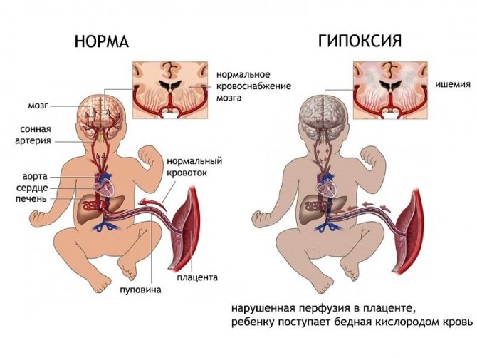 Нейросонография новорожденного: норма и гипоксия (из-за нарушенного кровоснабжения мозга)